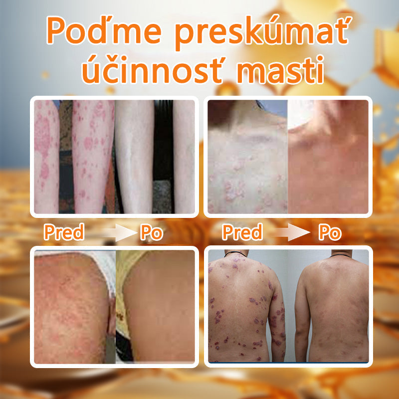 🌿Pokročilá masť na liečbu psoriázy Ourlyard™ (👨⚕Odporúčané lekárom) je certifikovaná Slovenským ústavom liečiv a zdravotníckych pomôcok (BFARM) a získala certifikáciu CE.