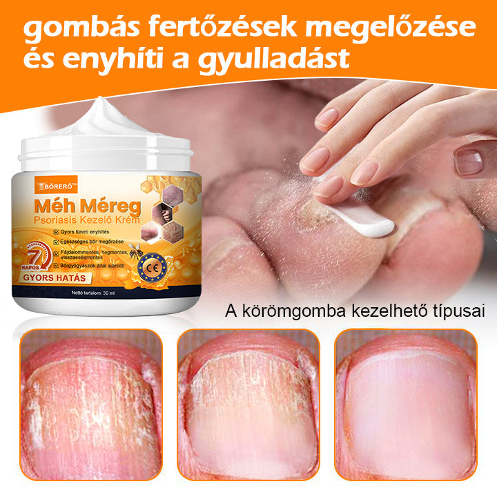 đăHivatalos MĂĄrkaboltăBĆRERĆâą MĂ©h MĂ©reg Psoriasis KezelĆ KrĂ©mïŒâPikkelysömörâSzemölcsâKörömgombaâïŒïŒ