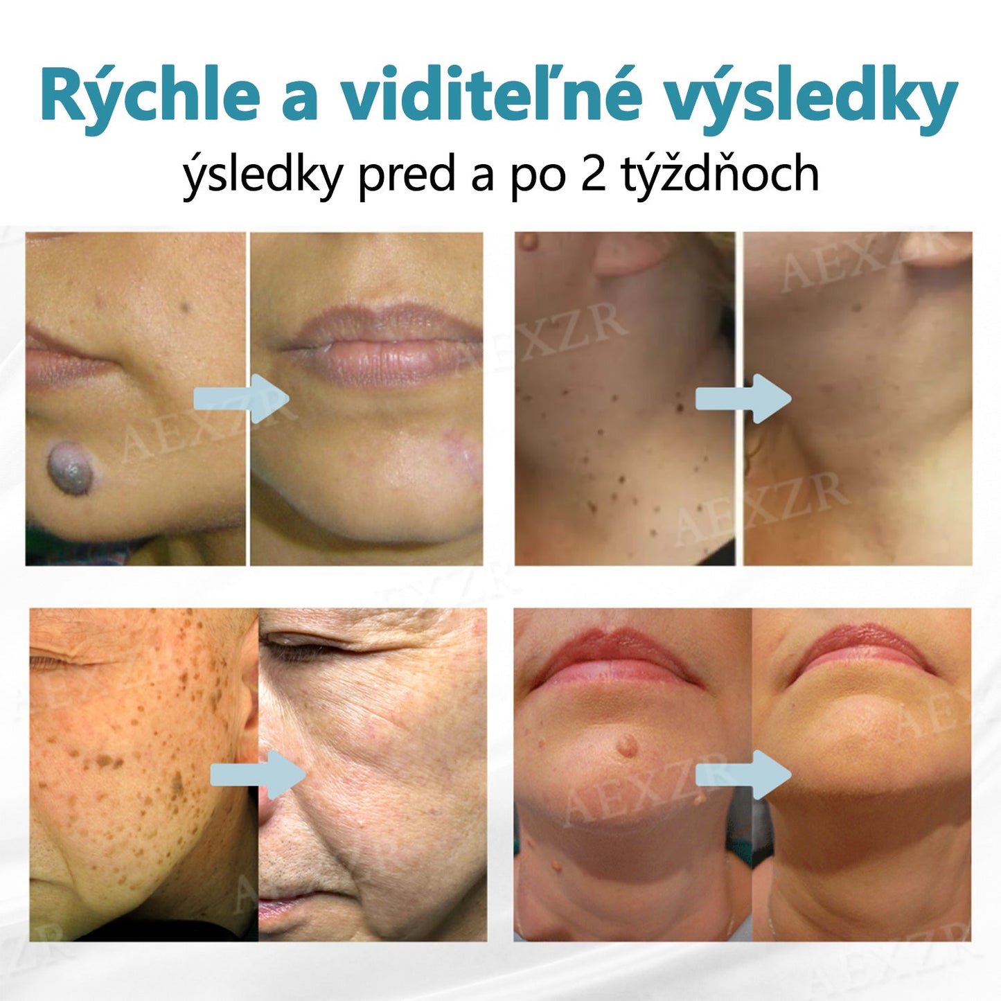 Bikenda®🎁 Neinvazívne laserové pero na odstránenie znamienok a bradavíc