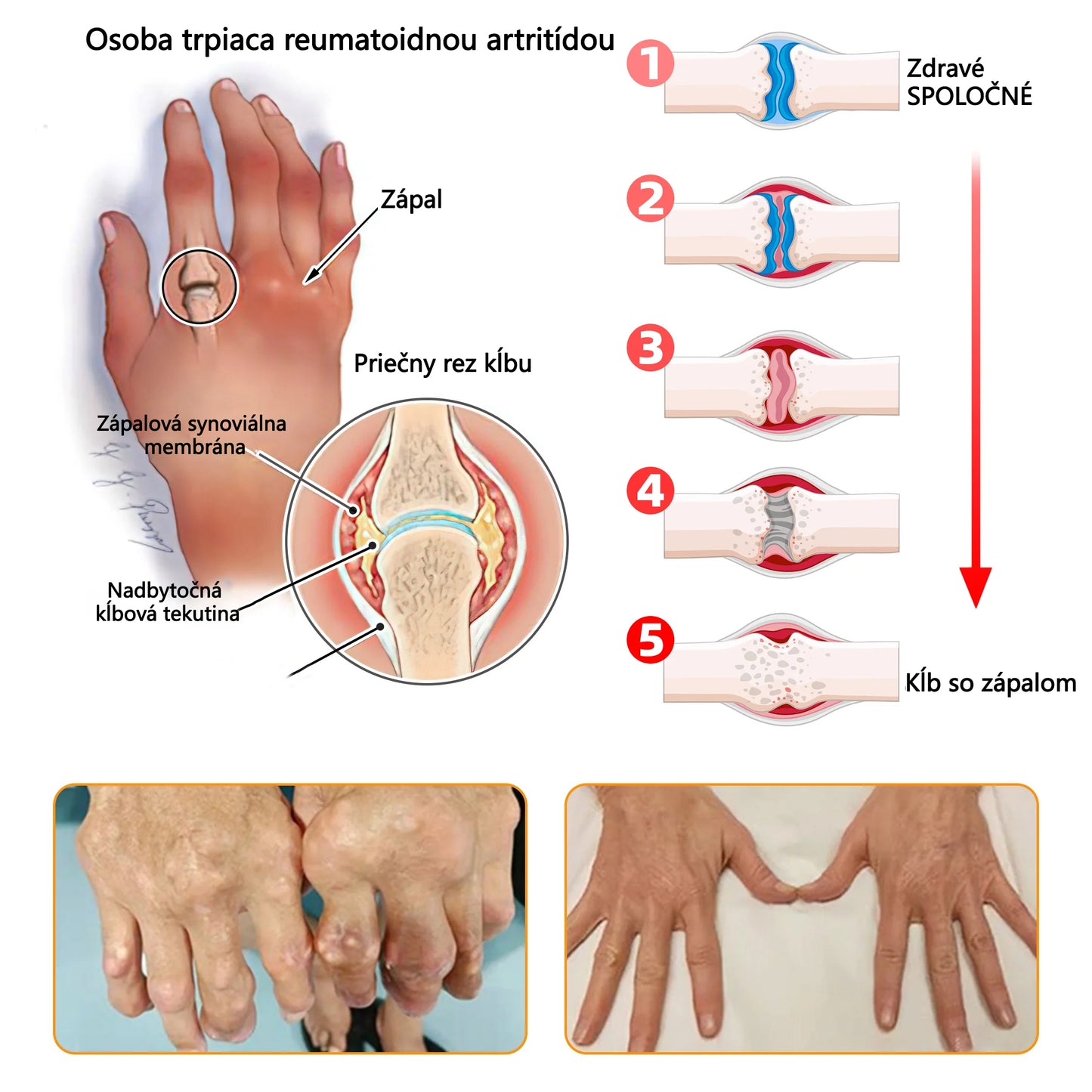 ADNOON® Krém na hojenie kostí s botulotoxínom a včelím jedom ⭐👨⚕️Schválené Slovenskou spoločnosťou ortopedie a traumatológie (SOTS)