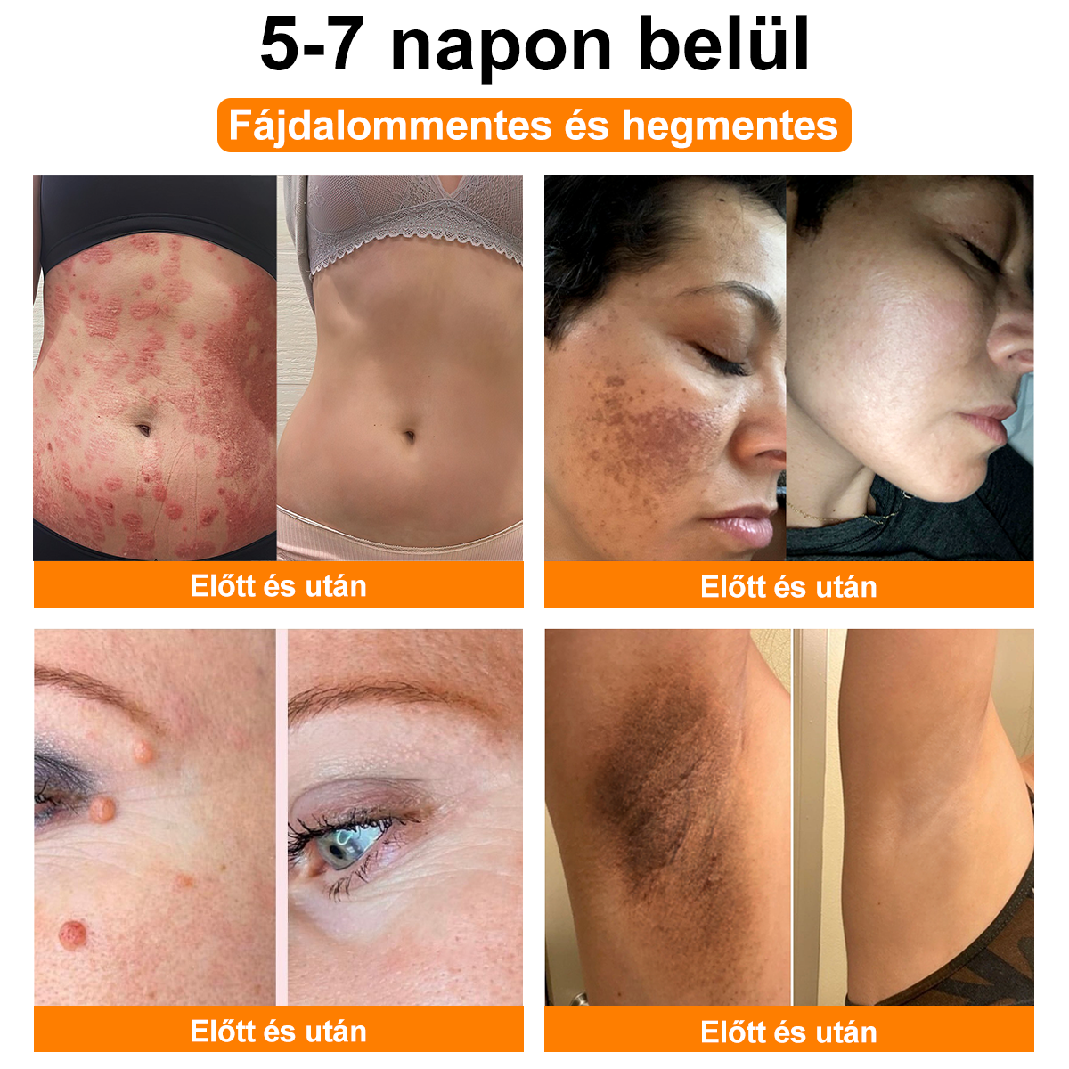 đăHivatalos MĂĄrkaboltăBĆRERĆâą MĂ©h MĂ©reg Psoriasis KezelĆ KrĂ©mïŒâPikkelysömörâSzemölcsâKörömgombaâïŒïŒ