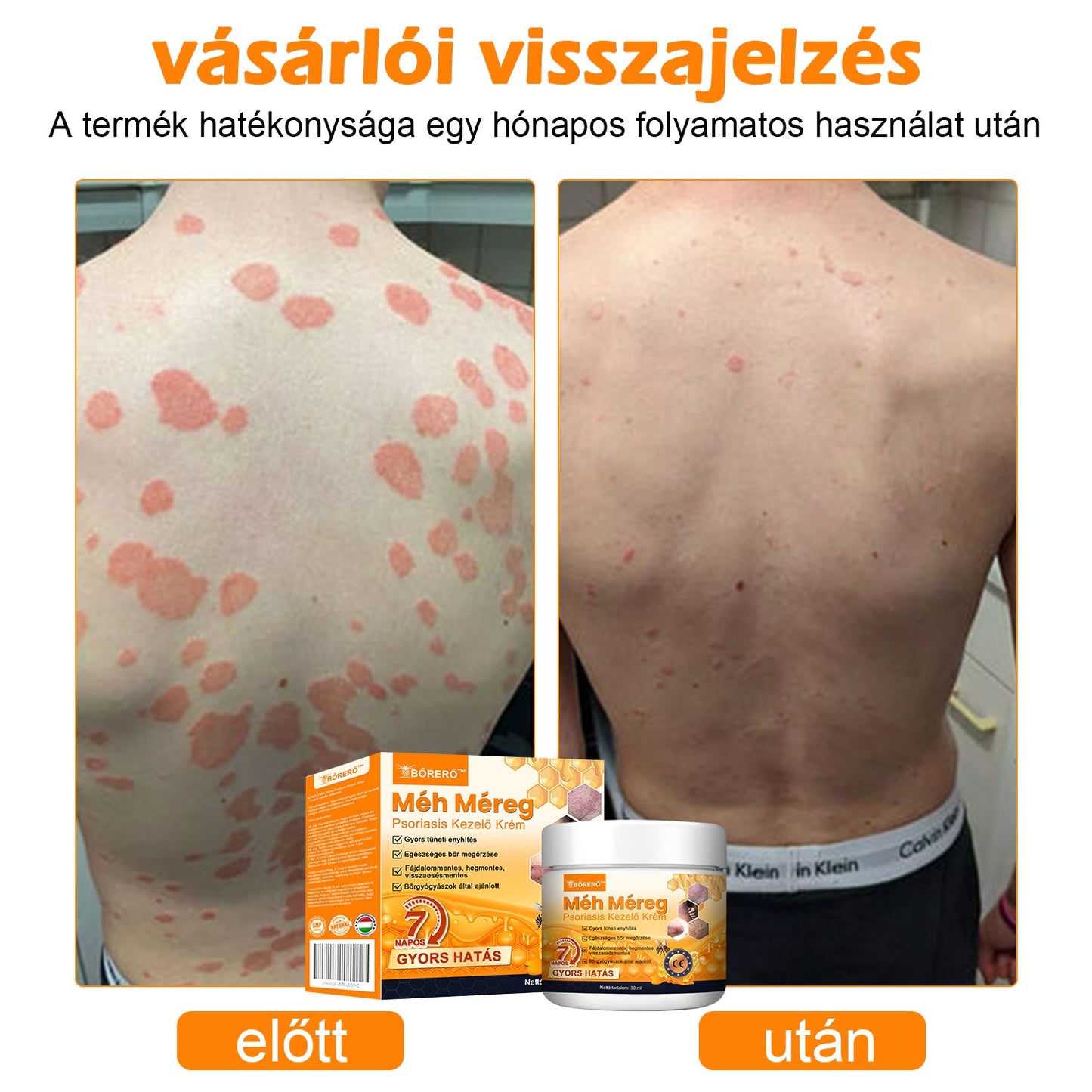 đăHivatalos MĂĄrkaboltăBĆRERĆâą MĂ©h MĂ©reg Psoriasis KezelĆ KrĂ©mïŒâPikkelysömörâSzemölcsâKörömgombaâïŒïŒ