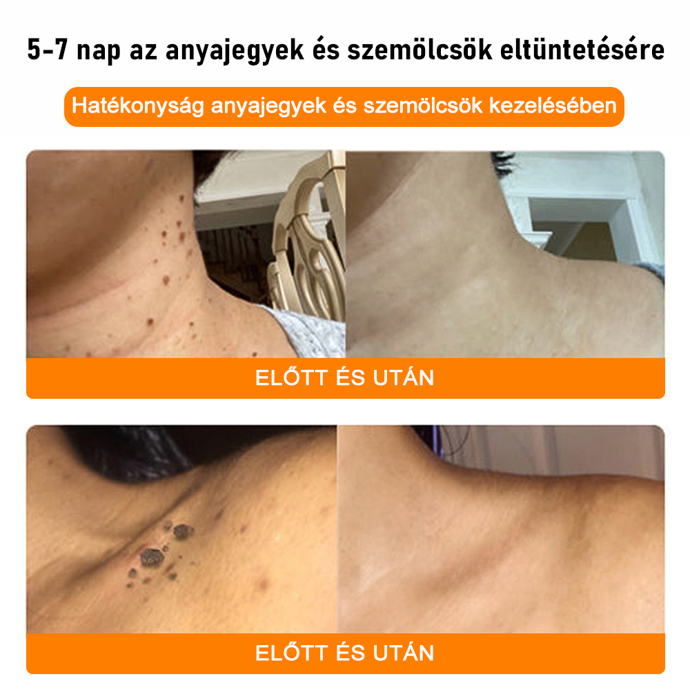 đăHivatalos MĂĄrkaboltăBĆRERĆâą MĂ©h MĂ©reg Psoriasis KezelĆ KrĂ©mïŒâPikkelysömörâSzemölcsâKörömgombaâïŒïŒ