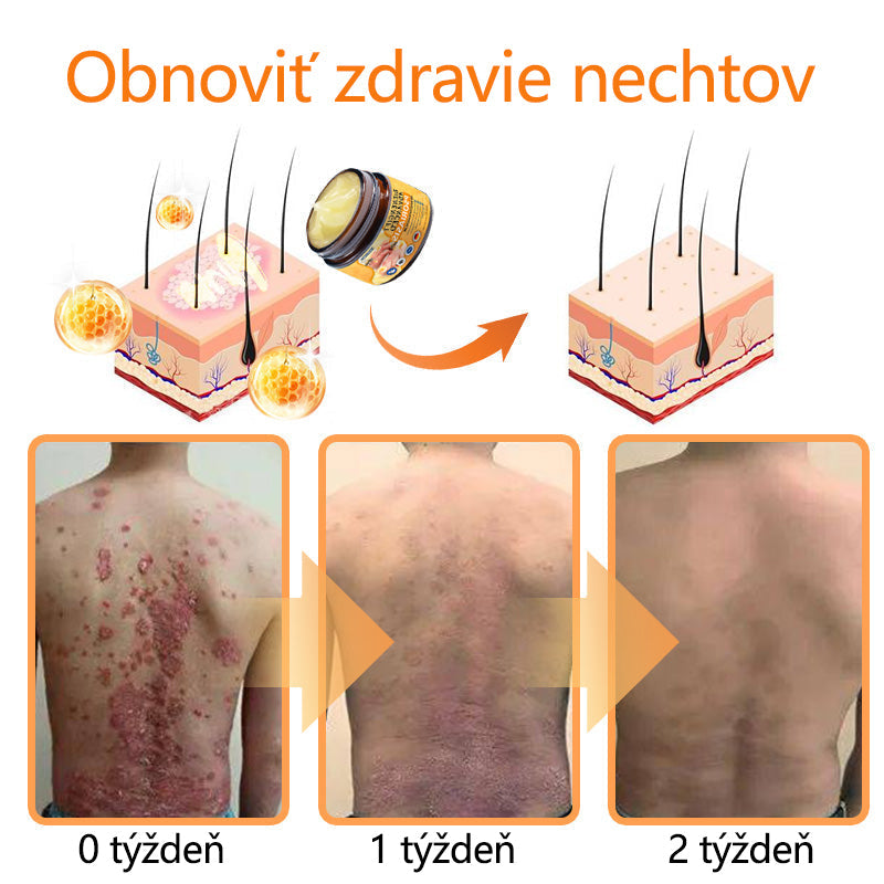 🌿Pokročilá masť na liečbu psoriázy Ourlyard™ (👨⚕Odporúčané lekárom) je certifikovaná Slovenským ústavom liečiv a zdravotníckych pomôcok (BFARM) a získala certifikáciu CE.