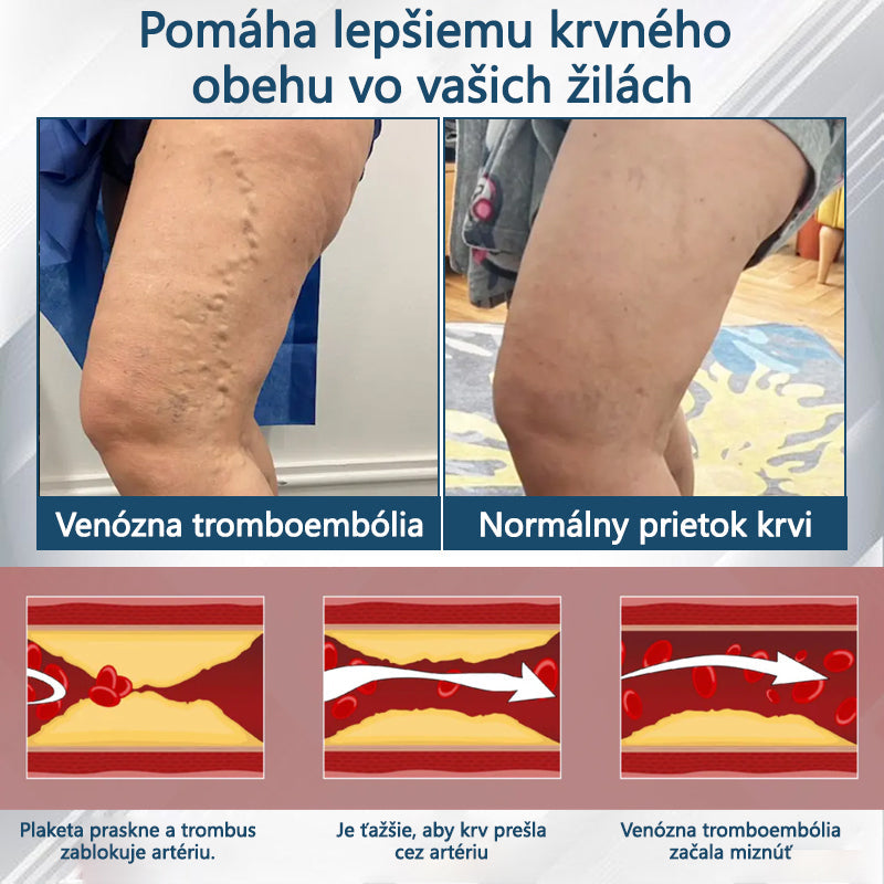 💧💧ATTDX® Bylinný krém na úľavu od opuchov s čiernou rascou
