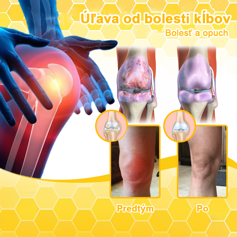 LOVILDS™ Včelí jed a kurkumový terapeutický krém na artritídu (👩🔬Špecializovaný na ortopedické ochorenia a bolesti kĺbov👩🔬)