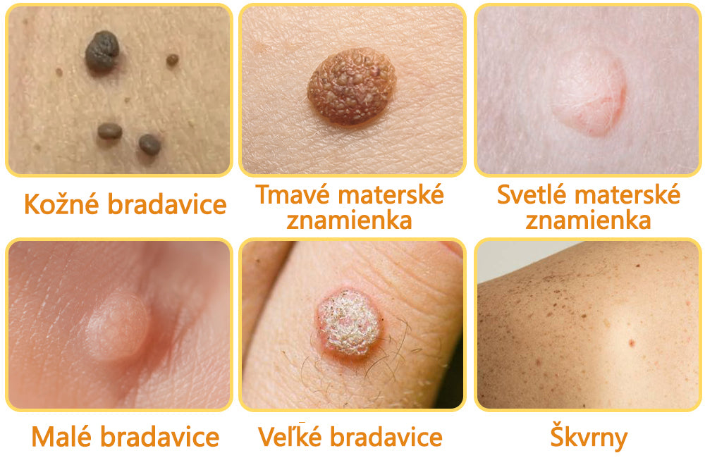 flysmus™ Ošetrenie Sprej na Včelím Jedom Na odstránenie kožných štítkov a bradavíc