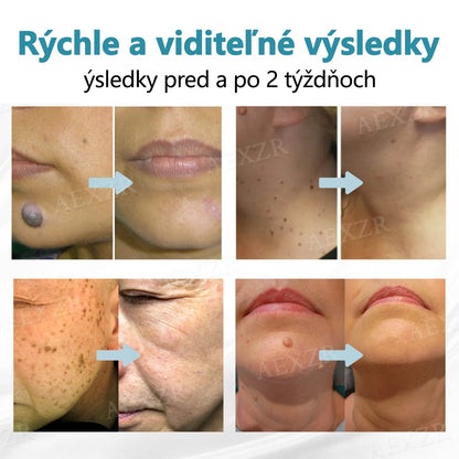 Bikenda®🎁 Neinvazívne laserové pero na odstránenie znamienok a bradavíc