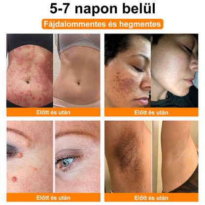 🏆【Hivatalos Márkabolt】BŐRERŐ™ Méh Méreg Psoriasis Kezelő Krém（⭐Pikkelysömör⭐Szemölcs⭐Körömgomba⭐））